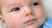 Аллергическая сыпь у новорожденных IsMama до года